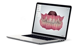 Intraoralscann